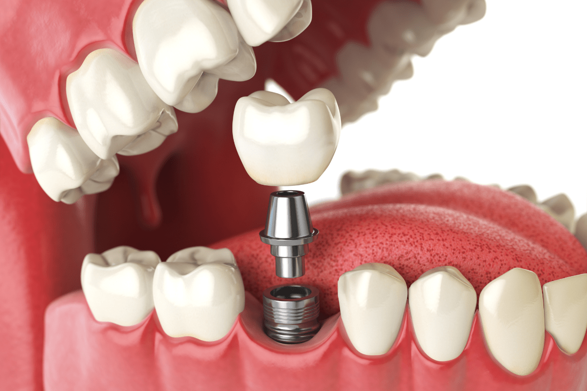 dental implants in Akurdi, Pune