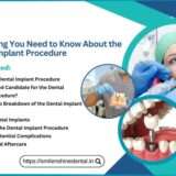 Dental Implant Procedure
